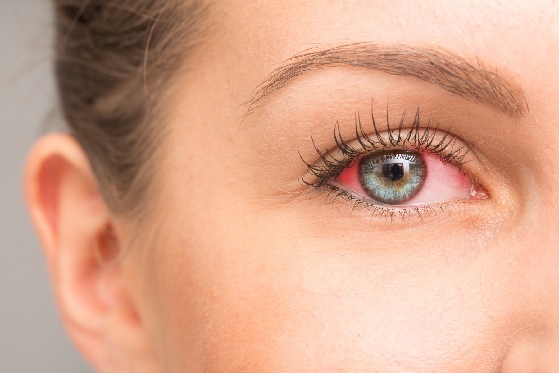 Eye redness from seasonal allergies